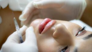 Lip Augmentation